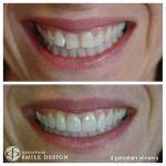 4-porcelain-veneers-woman-before-after-featured