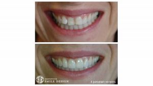4-porcelain-veneers-woman-before-after-featured