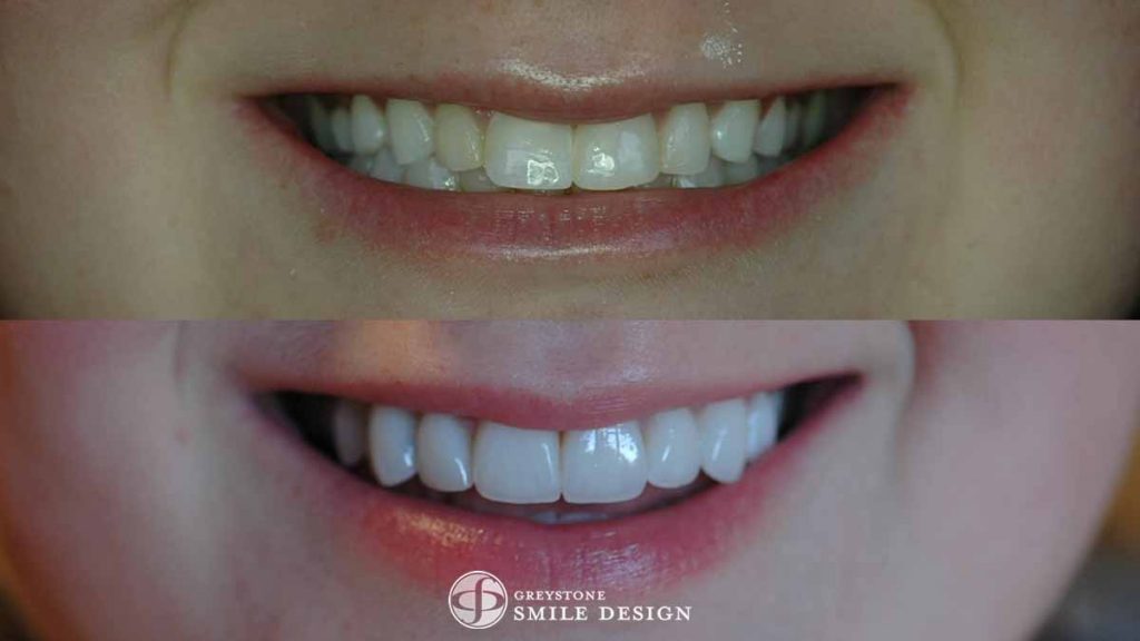 8-porcelain-veneers-replacing-composite-bonding-before-after-featured