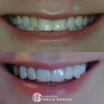 8-porcelain-veneers-replacing-composite-bonding-before-after-featured