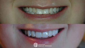 8-porcelain-veneers-replacing-composite-bonding-before-after-featured