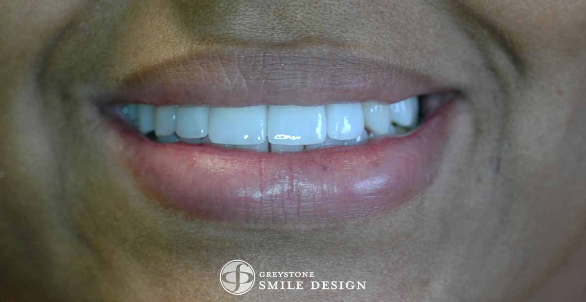 after-photo-of-4-porcelain-veneers-front-teeth-closeup