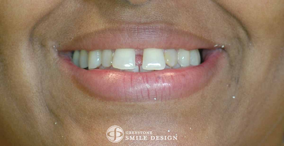 before-photo-of-4-porcelain-veneers-front-teeth-closeup-3