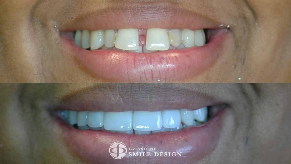 featured-image-4-porcelain-veneers-front-teeth-closeup