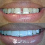 featured-image-4-porcelain-veneers-front-teeth-closeup