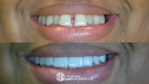 featured-image-4-porcelain-veneers-front-teeth-closeup