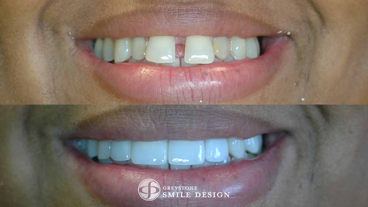 featured-image-4-porcelain-veneers-front-teeth-closeup