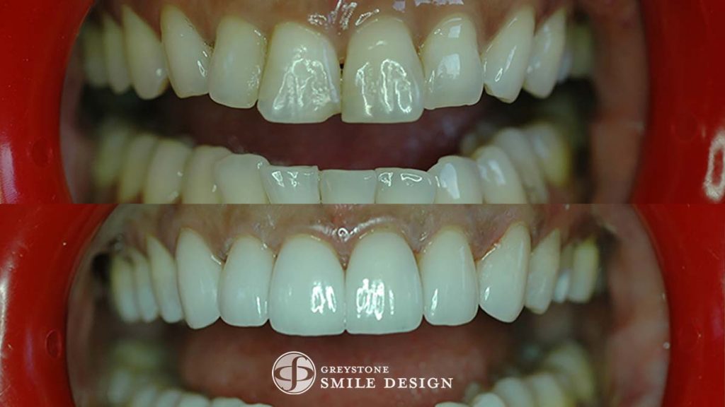6-veneers-before-after-featured