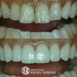 6-veneers-before-after-featured
