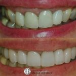 10-porcelain-veneers-featured