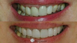 10-porcelain-veneers-featured