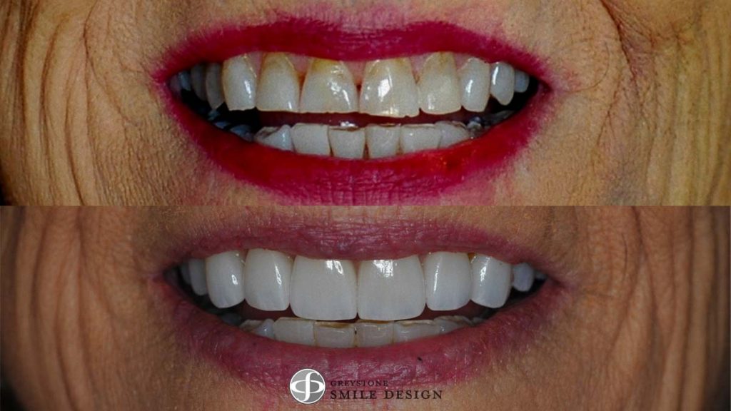10-porcelain-veneers-featured