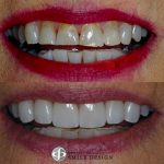 10-porcelain-veneers-featured
