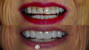 10-porcelain-veneers-featured