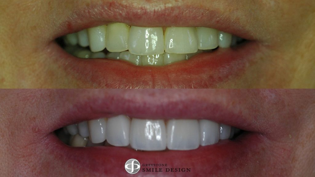 4-porcelain-veneers-before-after-featured