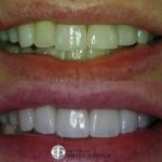 4-porcelain-veneers-before-after-featured