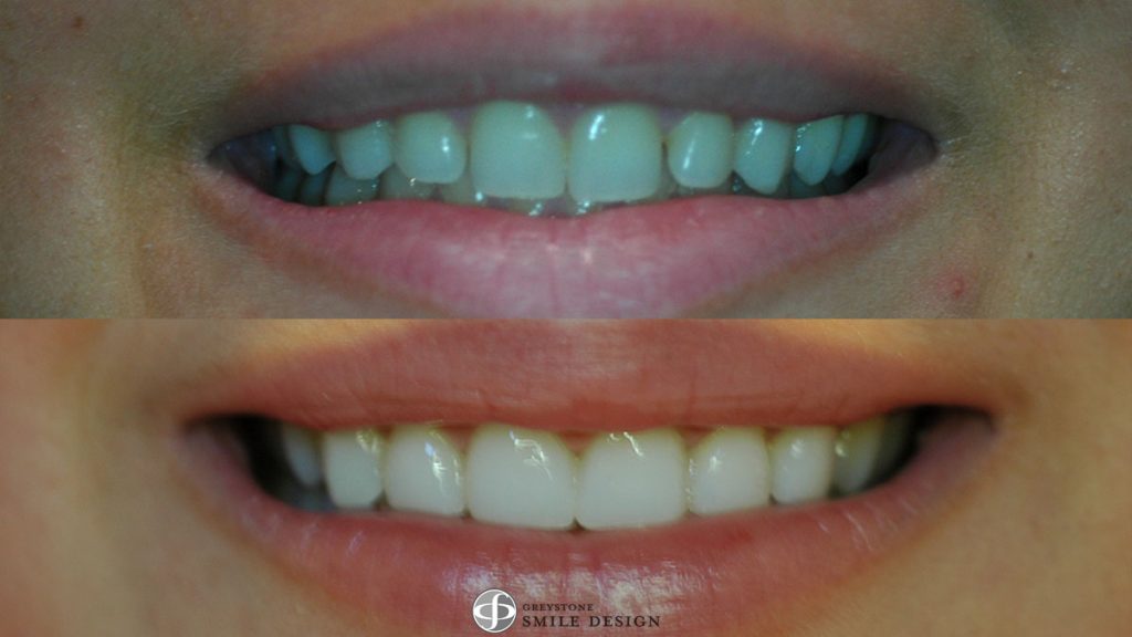 6-composite-veneers-before-after-featured