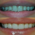 6-composite-veneers-before-after-featured
