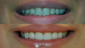 6-composite-veneers-before-after-featured