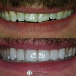 6-porcelain-veneers-before-after-featured
