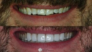 6-porcelain-veneers-before-after-featured